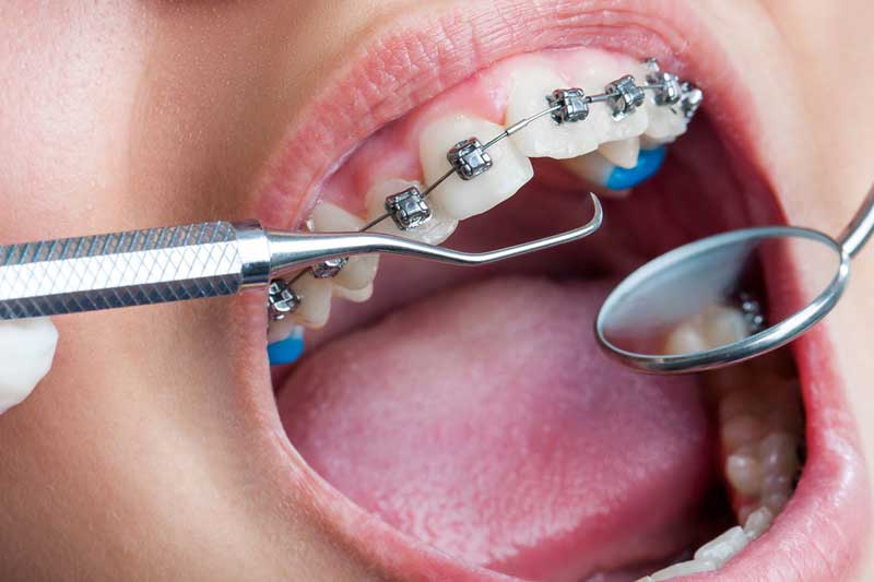 braces-treatment