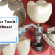 Tooth-Bonding-Treatment